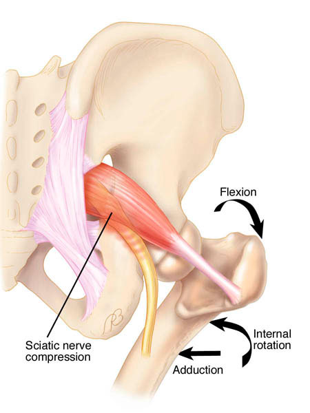 piriformis syndrome causes irritation of the sciatic nerve