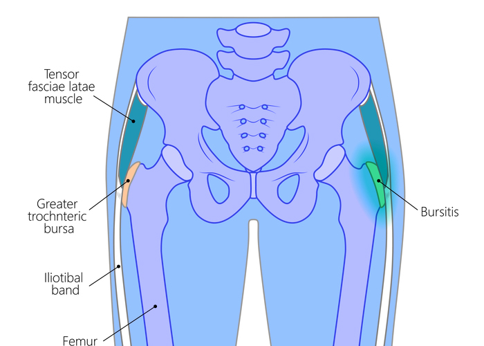 Trochanter Bursitis Ursachen Behandlung Und bungen NZVRSU Trochanter Bursitis Ursachen Behandlung Und bungen NZVRSU