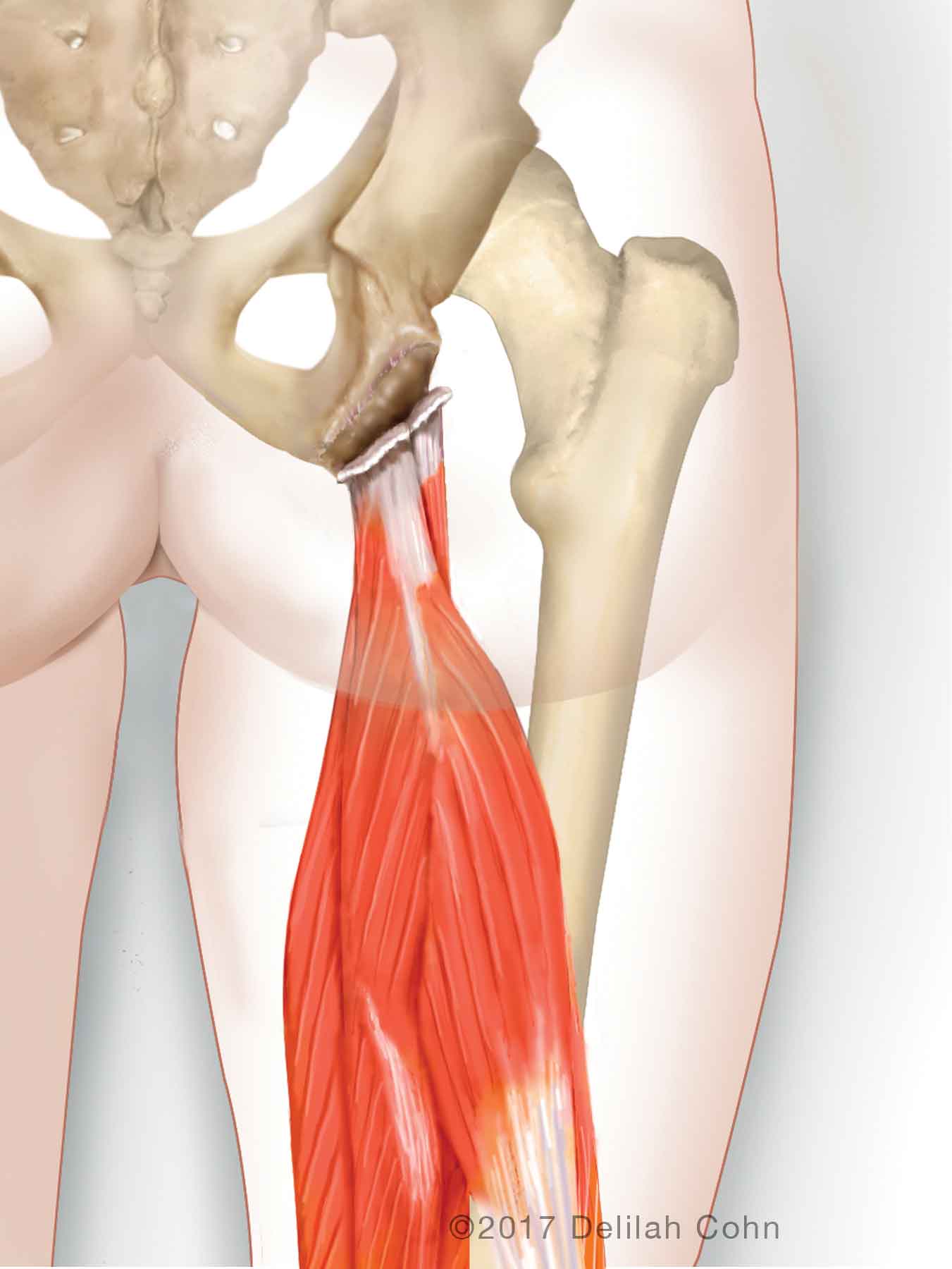 Hamstring Injuries Biceps Femoris Semitendinosus Semimembranosus