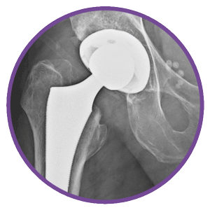 Hip-Replacement-300