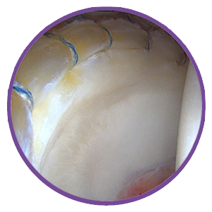 Hip-Arthroscopy-300-2_preview